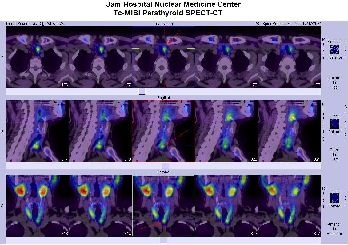 Parathyroid SPECT-CT